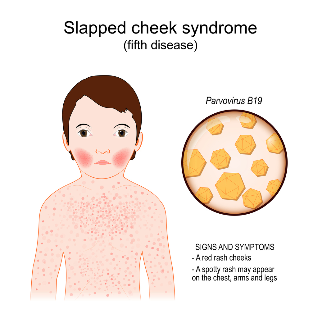 Bright Red Cheeks and Fifth Disease